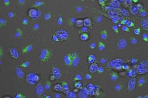 Cáncer de mama triple negativo y avance en tratamiento con MACTIDE-V