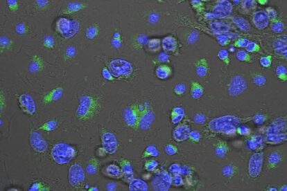 Cáncer de mama triple negativo y avance en tratamiento con MACTIDE-V