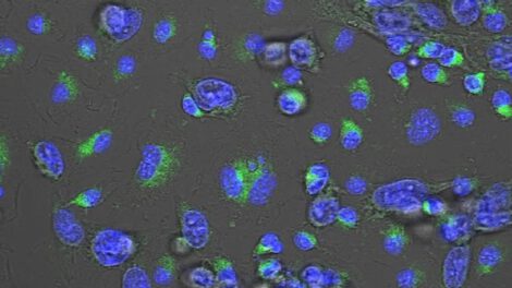 Cáncer de mama triple negativo y avance en tratamiento con MACTIDE-V