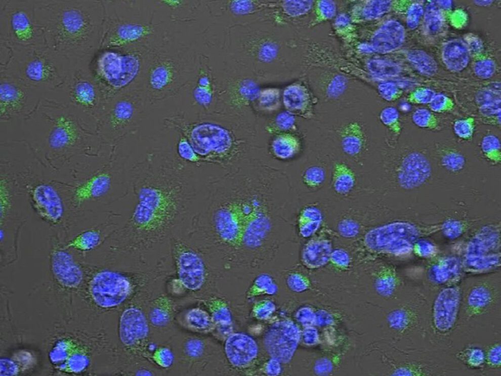 Cáncer de mama triple negativo y avance en tratamiento con MACTIDE-V