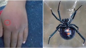 Una estudiante de 12 años sufrió la picadura de una araña viuda negra