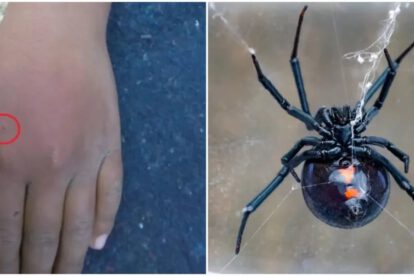 Una estudiante de 12 años sufrió la picadura de una araña viuda negra