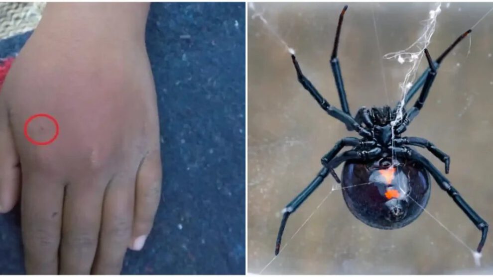 Una estudiante de 12 años sufrió la picadura de una araña viuda negra