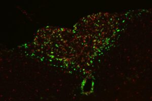 Apatía en cáncer avanzado relacionada con inflamación