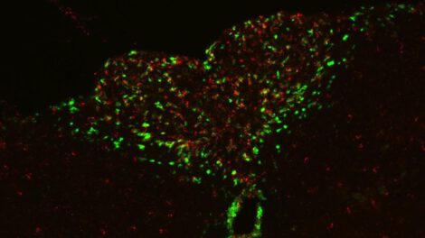 Apatía en cáncer avanzado relacionada con inflamación