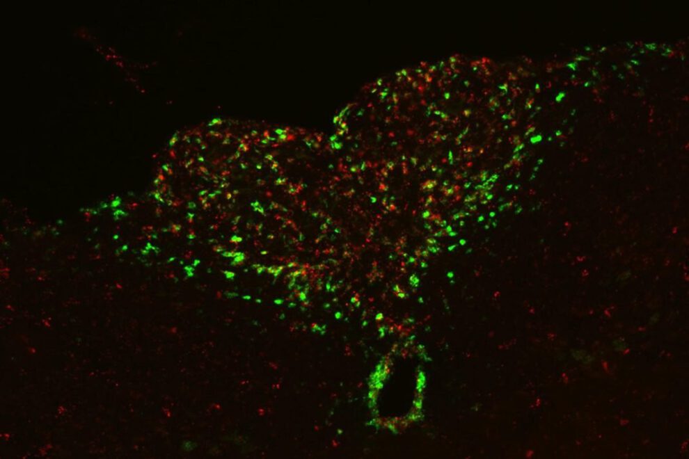 Apatía en cáncer avanzado relacionada con inflamación