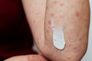 contagios de varicela en La Paz