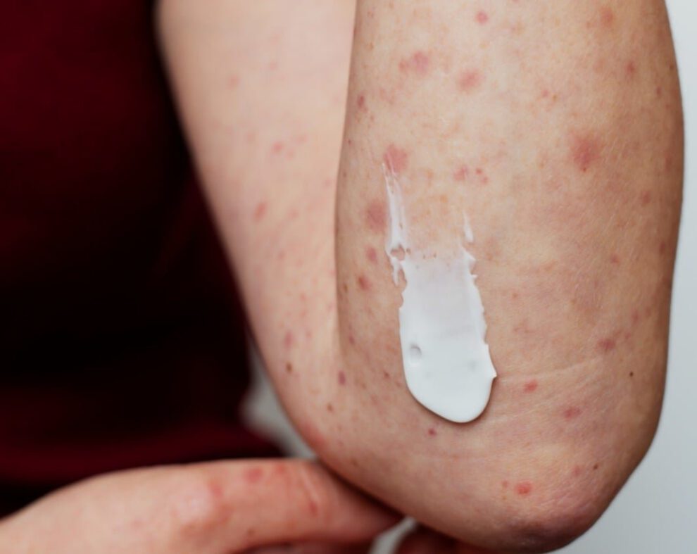 contagios de varicela en La Paz