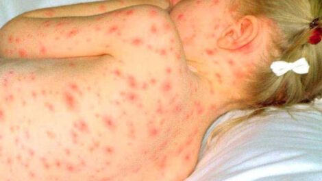 Aumentan a 42 casos de varicela en Potosí