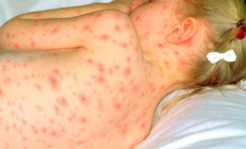 Aumentan a 42 casos de varicela en Potosí