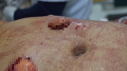 Intento de feminicidio: Mujer fue apuñalada 16 veces por su esposo