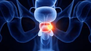 Día Mundial del Cáncer de Próstata y su detección precoz