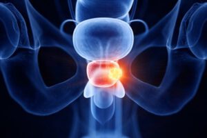 Día Mundial del Cáncer de Próstata y su detección precoz
