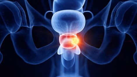 Día Mundial del Cáncer de Próstata y su detección precoz
