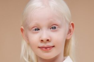 Día Internacional de Concienciación sobre el Albinismo