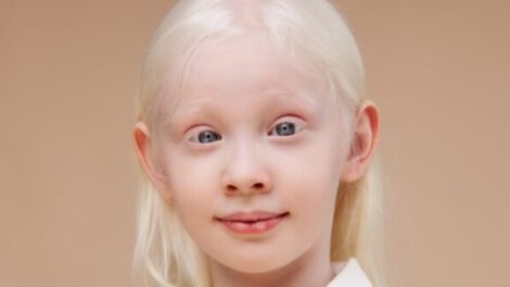 Día Internacional de Concienciación sobre el Albinismo