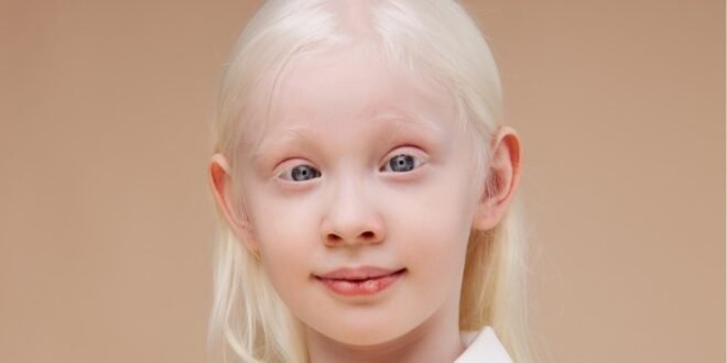 Día Internacional de Concienciación sobre el Albinismo