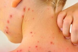 casos de sarampión en Bolivia