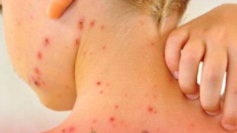 casos de sarampión en Bolivia