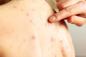 Brote de sarampión en Bolivia