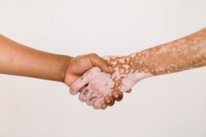 Día Mundial del Vitiligo: Una enfermedad que afecta al 2% de la población global