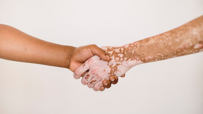 Día Mundial del Vitiligo: Una enfermedad que afecta al 2% de la población global