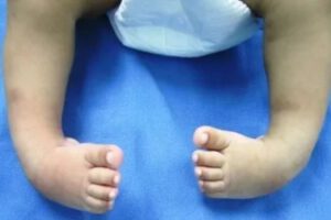 Artrogriposis Múltiple Congénita y sus retos en el tratamiento