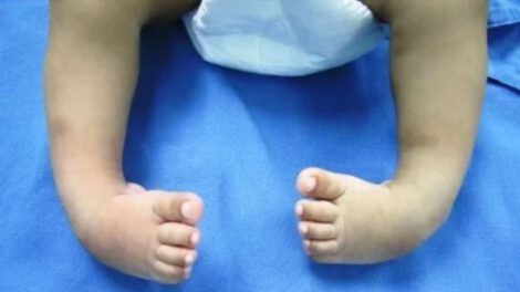 Artrogriposis Múltiple Congénita y sus retos en el tratamiento