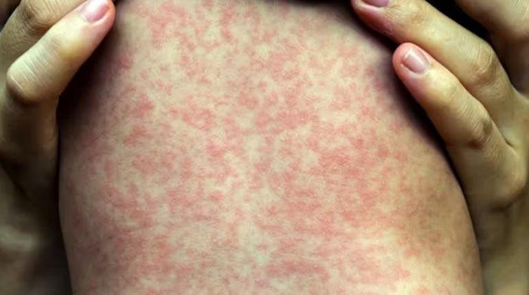 Primer caso de sarampión en Beni