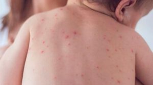 Un niño con sarampión en Chuquisaca
