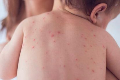 Un niño con sarampión en Chuquisaca