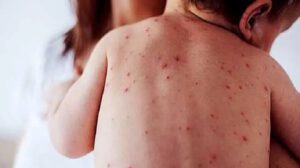 Brote epidémico de sarampión afecta principalmente a menores
