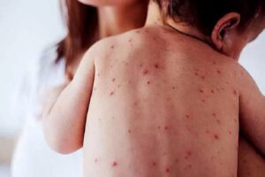 Brote epidémico de sarampión afecta principalmente a menores