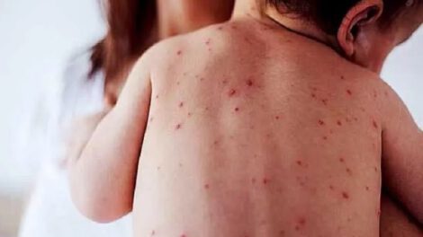 Brote epidémico de sarampión afecta principalmente a menores