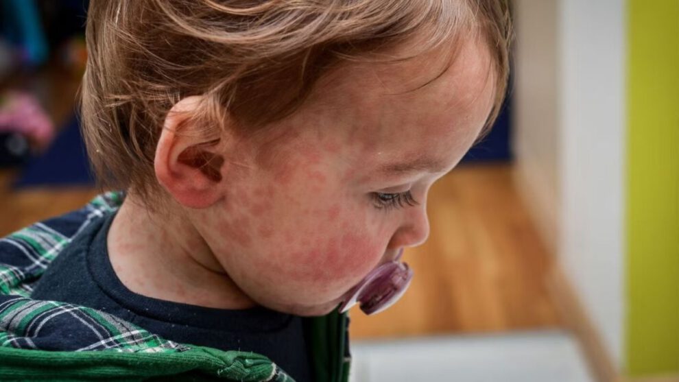 Aumento de casos de sarampión en Estados Unidos