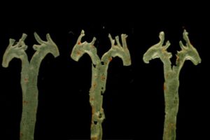 diagnóstico de aterosclerosis