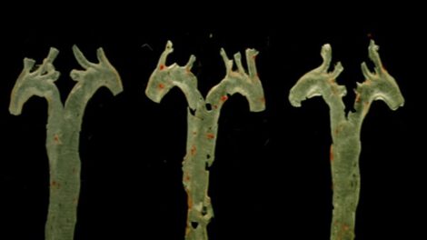 diagnóstico de aterosclerosis