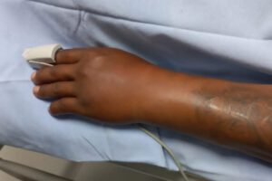 Picadura de viuda negra en Oruro