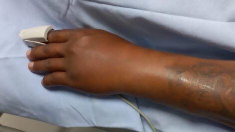 Picadura de viuda negra en Oruro