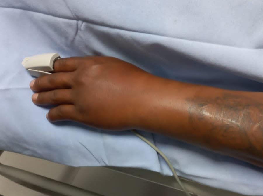 Picadura de viuda negra en Oruro