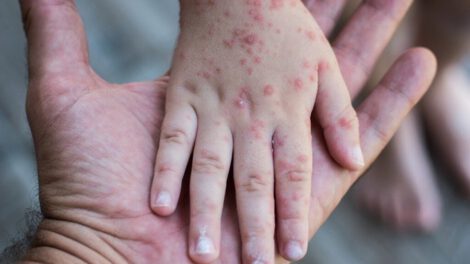 sarampión en Yacuiba