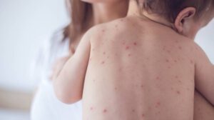 alerta sanitaria sarampión Tarija