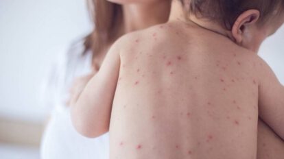 alerta sanitaria sarampión Tarija
