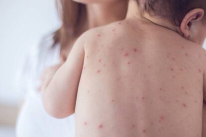 alerta sanitaria sarampión Tarija