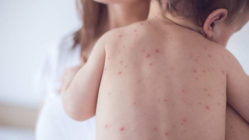 alerta sanitaria sarampión Tarija