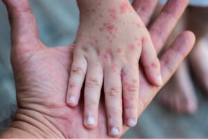 Advierten aumento en casos por sarampión