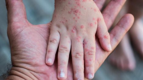 Advierten aumento en casos por sarampión