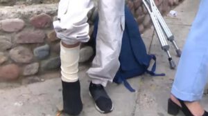 Niña que sufrio una fractura en una de sus piernas tras el robo de su celular