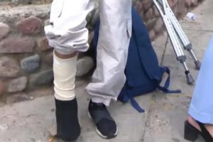 Niña que sufrio una fractura en una de sus piernas tras el robo de su celular