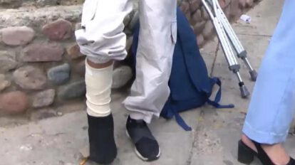 Niña que sufrio una fractura en una de sus piernas tras el robo de su celular